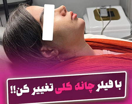 فیلر چانه