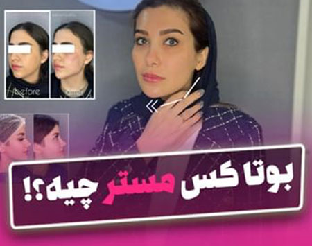 بوتاکس مستر