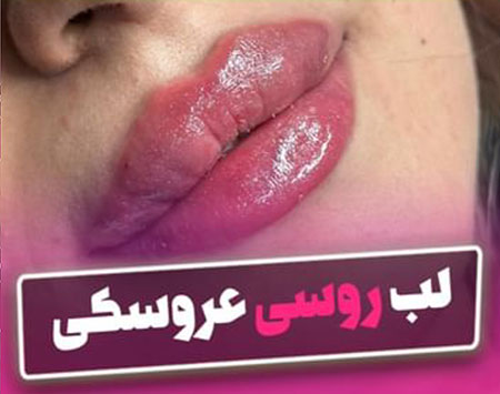 فیلر لب