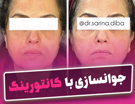 جوانسازی