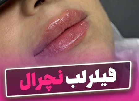 فیلر لب