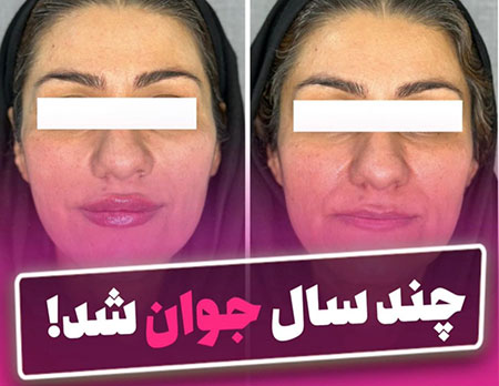 جوانسازی