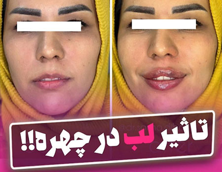 فیلر لب