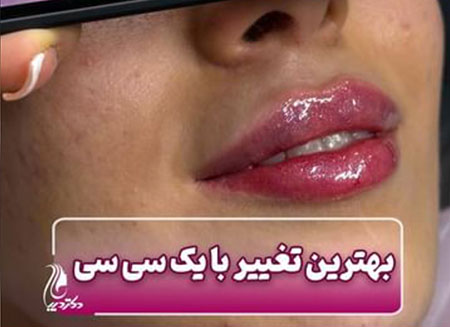فیلر لب | دکتر دیبا