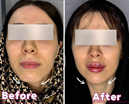 فیلر چانه | دکتر سارینا دیباوری | کلینیک دکتر دیبا | پزشک پوست، مو و زیبایی شهر قدس