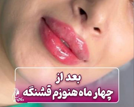 ماندگاری فیلر لب | دکتر سارینا دیباوری | کلینیک دکتر دیبا | پزشک پوست، مو و زیبایی شهر قدس