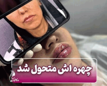 لب نچرال | دکتر سارینا دیباوری | کلینیک دکتر دیبا | پزشک پوست، مو و زیبایی شهر قدس