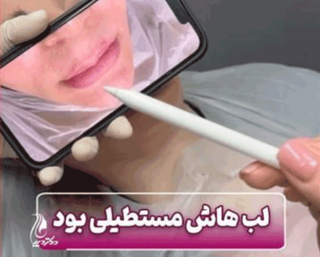 تزریق آنزیم | دکتر سارینا دیباوری | کلینیک دکتر دیبا | پزشک پوست، مو و زیبایی شهر قدس