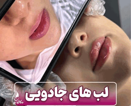لب زیبا | دکتر سارینا دیباوری | کلینیک دکتر دیبا | پزشک پوست، مو و زیبایی شهر قدس