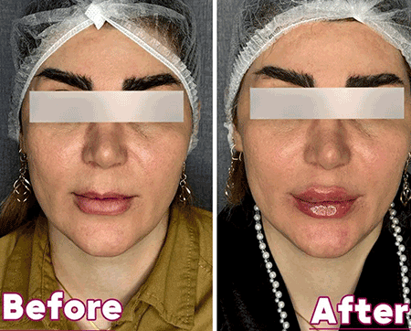اصلاح فیلر لب | دکتر سارینا دیباوری | کلینیک دکتر دیبا | پزشک پوست، مو و زیبایی شهر قدس