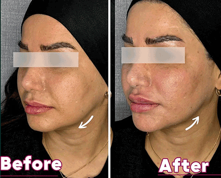 لیفت صورت | دکتر سارینا دیباوری | کلینیک دکتر دیبا | پزشک پوست، مو و زیبایی شهر قدس