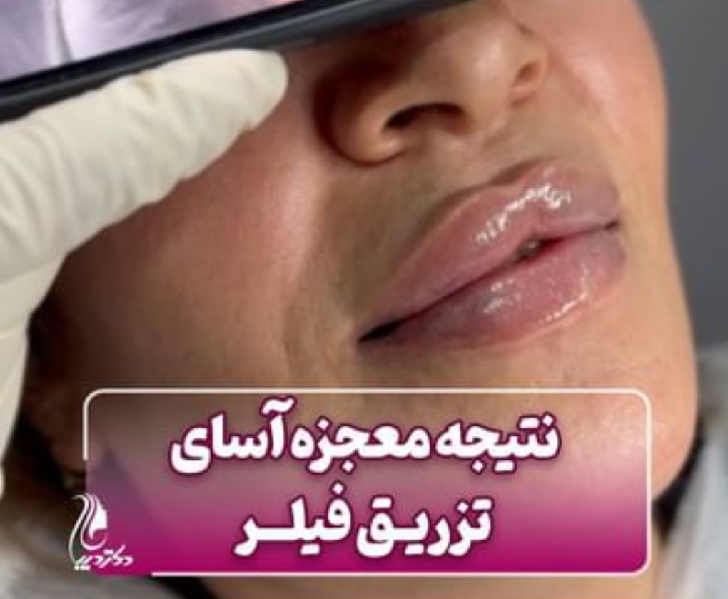 بهترین مرکز تزریق فیلر لب روسی شهر قدس | دکتر سارینا دیباوری | کلینیک دکتر دیبا | پزشک پوست، مو و زیبایی شهر قدس