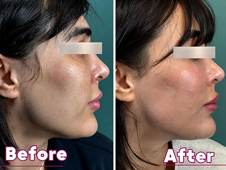 بهترین مرکز تزریق کانتور صورت شهر قدس | کانتورینگ | زاویه سازی صورت | مدلینگ صورت | دکتر سارینا دیباوری | کلینیک دکتر دیبا | پزشک پوست، مو و زیبایی شهر قدس