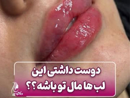 لب روسی | بهترین مرکز تزریق فیلر لب روسی شهر قدس | دکتر سارینا دیباوری | کلینیک دکتر دیبا | پزشک پوست، مو و زیبایی شهر قدس