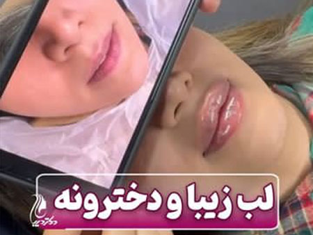 لب روسی نچرال | بهترین کلینیک تزریق فیلر لب روسی شهر قدس | دکتر سارینا دیباوری | کلینیک دکتر دیبا | پزشک پوست، مو و زیبایی شهر قدس