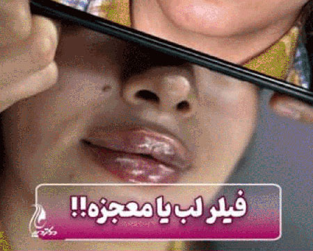 بهترین مرکز تزریق فیلر لب شهر قدس | دکتر سارینا دیباوری | کلینیک دکتر دیبا | پزشک پوست، مو و زیبایی شهر قدس