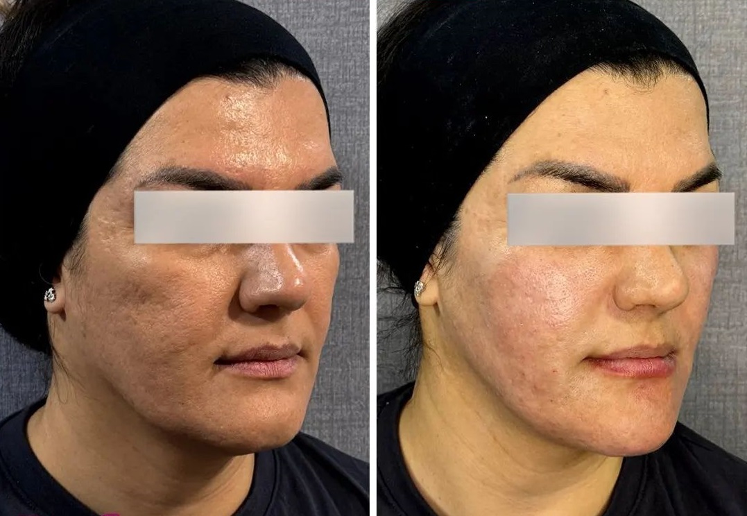 لیفت صورت | دکتر سارینا دیباوری | کلینیک دکتر دیبا | پزشک پوست، مو و زیبایی شهر قدس