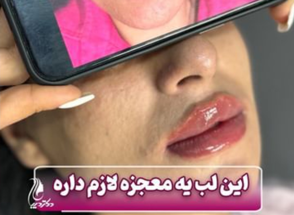 فیلر لب | دکتر سارینا دیباوری | کلینیک دکتر دیبا | پزشک پوست، مو و زیبایی شهر قدس