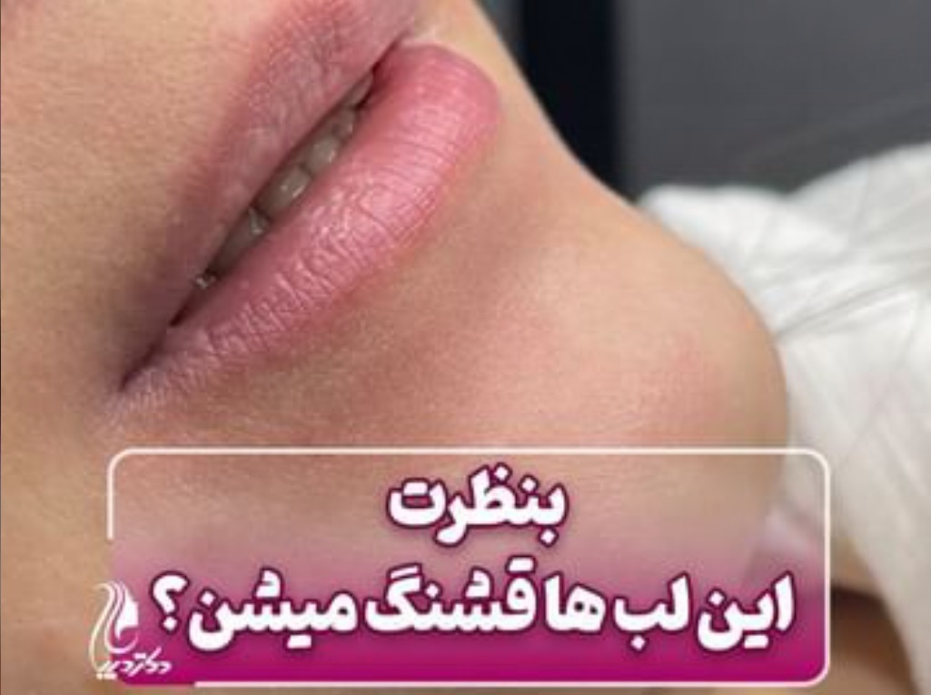 فیلر لب | دکتر سارینا دیباوری | کلینیک دکتر دیبا | پزشک پوست، مو و زیبایی شهر قدس
